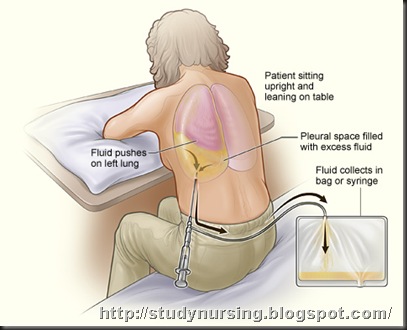 Nursing Articles: Thoracentesis